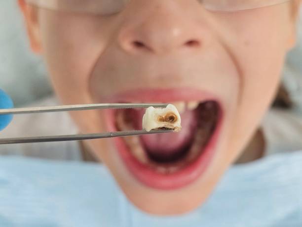 Best Emergency Dentist for Lost Fillings or Crowns in Middleport, OH